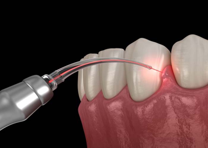 Laser Dentistry