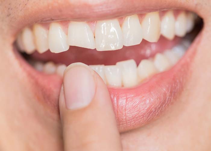 Tooth Trauma