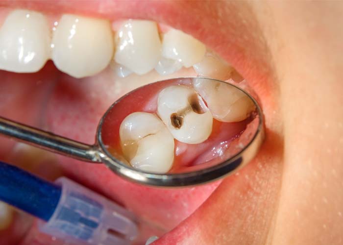 Cavity Filling