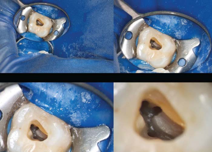 Root Canal Treatment