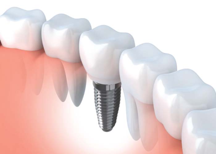 Implants