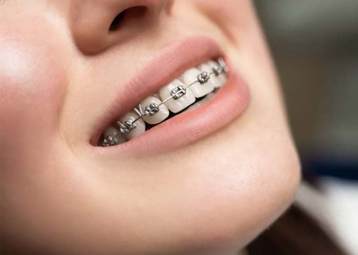 Orthodontic Care