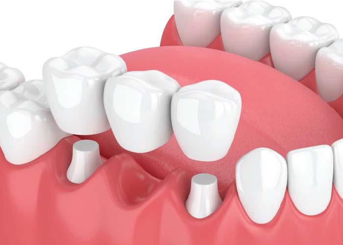 Dental Crowns