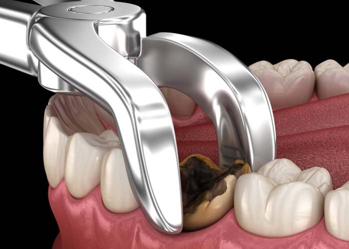 Tooth Extraction