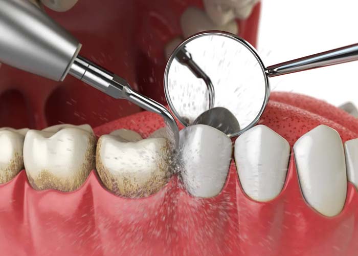 Teeth Cleaning