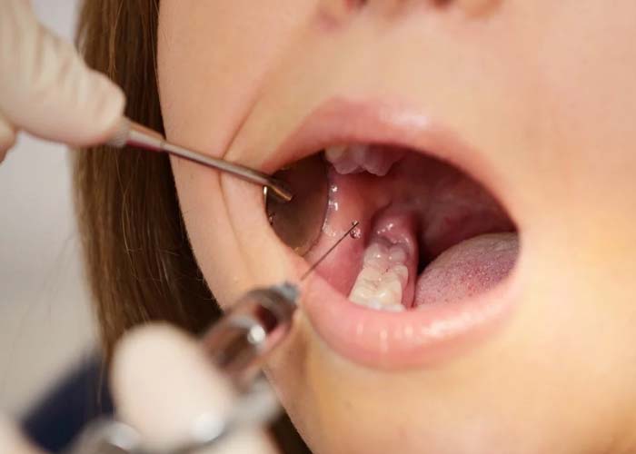 Local Anesthesia